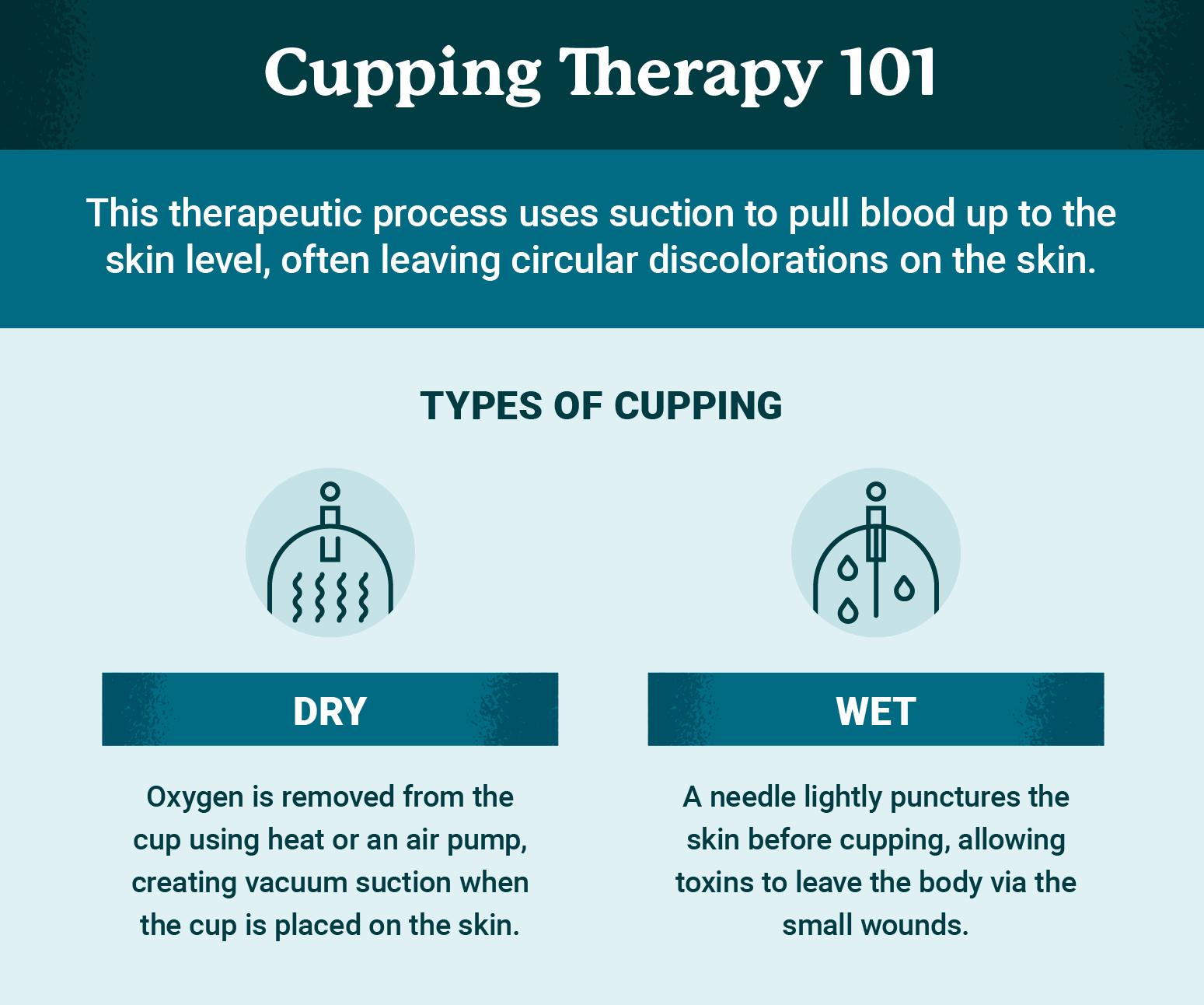 Cupping therapy 101 graphic explains types of cupping